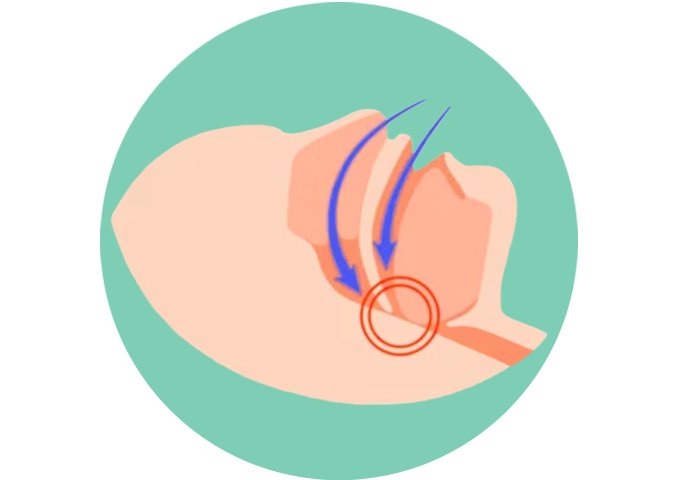 睡眠時無呼吸症候群